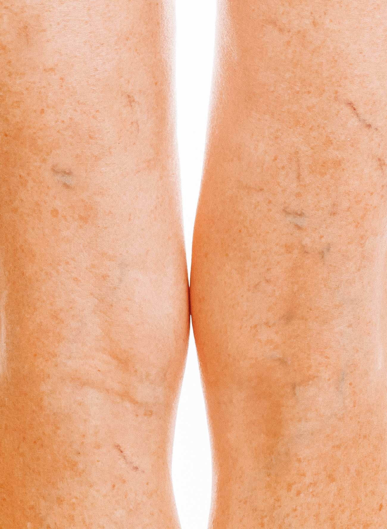 SCLEROTHERAPY