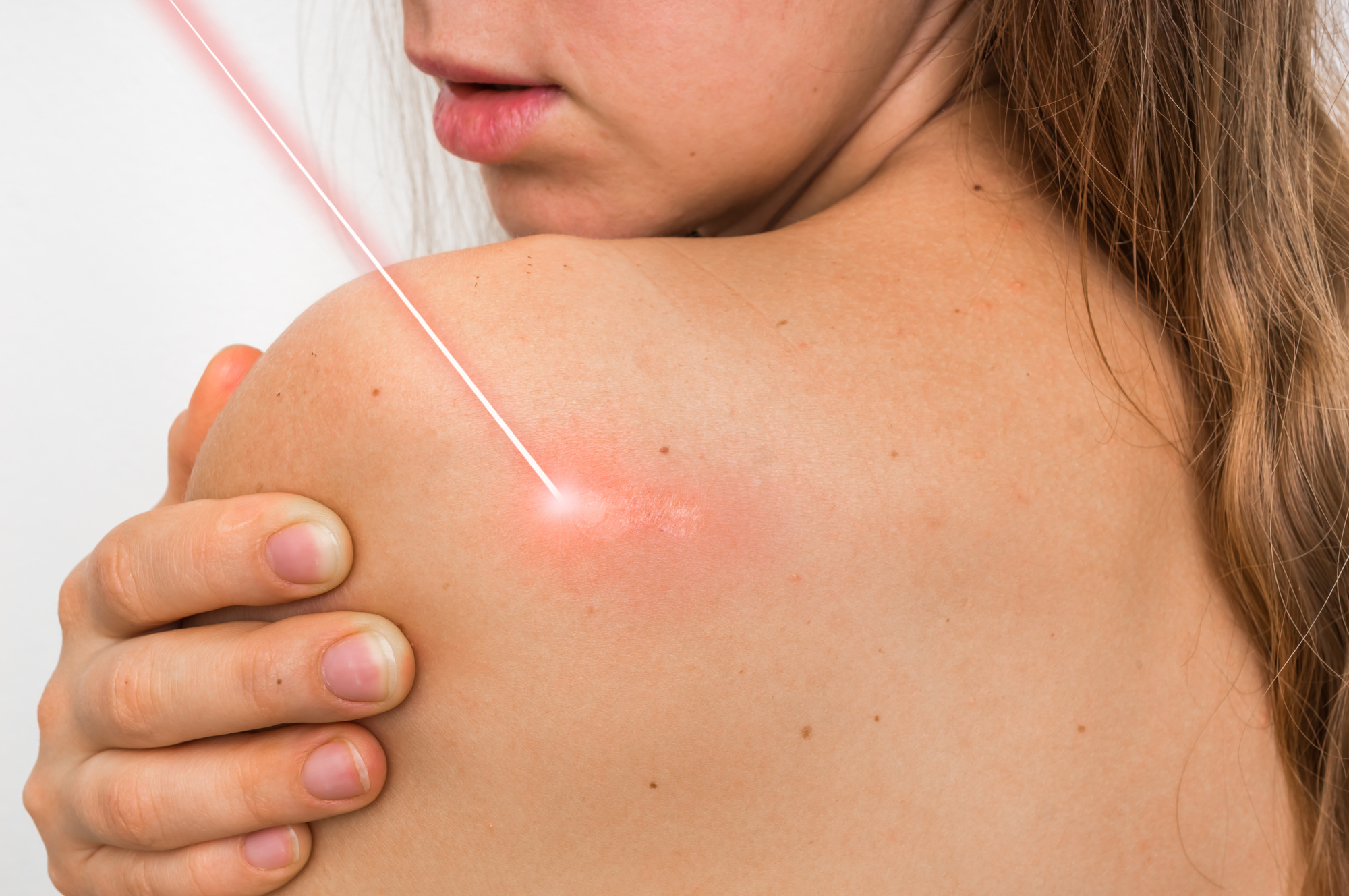 Get to Know Pixel Laser Treatment: Is It the Right Treatment for You?